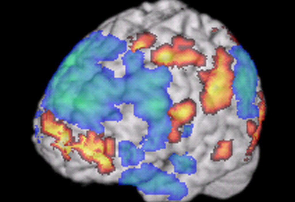 El LSD desafina al cerebro: la neuroimagen muestra cómo se rompe la sincronía entre neuronas vecinas
