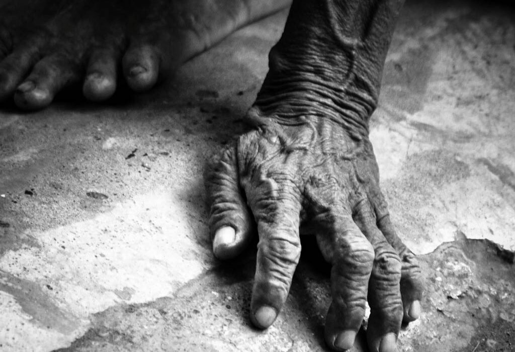 La psilocibina protegió células de la piel del envejecimiento provocado por azúcar y grasa, en un ensayo de laboratorio