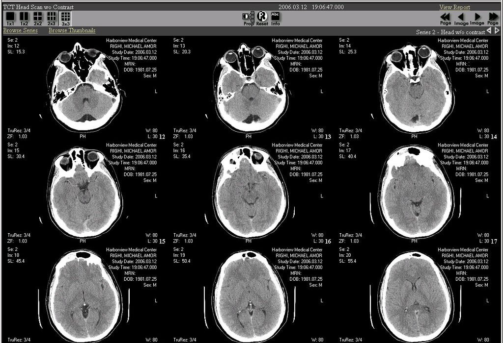Una sola dosis de psilocibina deja huellas en el cerebro que duran un mes