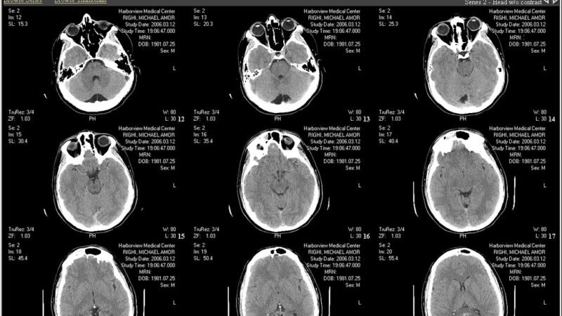 Imagen de resonancia magnética del cerebro