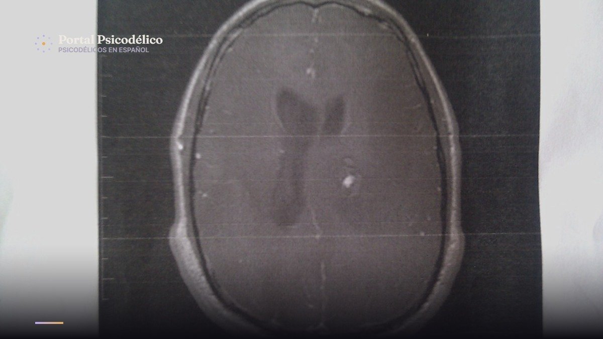 Qué cambia en el cerebro tras la primera dosis de psilocibina, según Imperial College London
