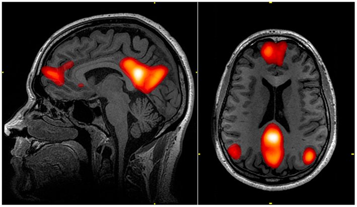 Red neuronal por defecto (default mode network) en imagen cerebral