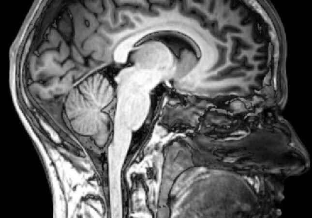 Resonancia magnética sagital de un cerebro humano